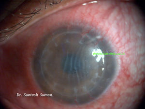 Acute-Rejection-after-Corneal-Transplant