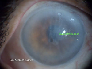 Hazy cornea due to Corneal Decompensation