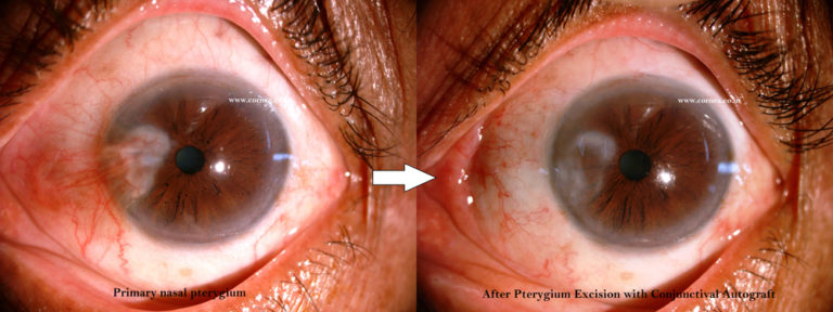 Pterygium – Cornea